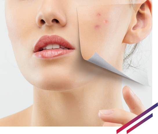 Cosmetic industry, efficacy models anti-acne